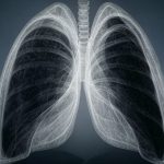 Peritonitis